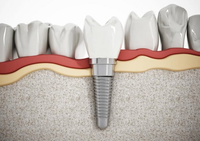 Dental implant detail